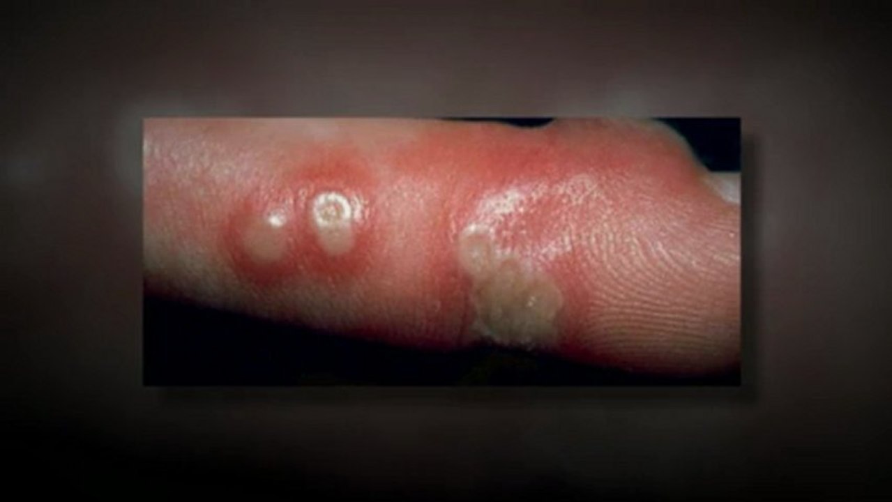PICTURES OF HERPES