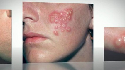 SIGNS OF HERPES
