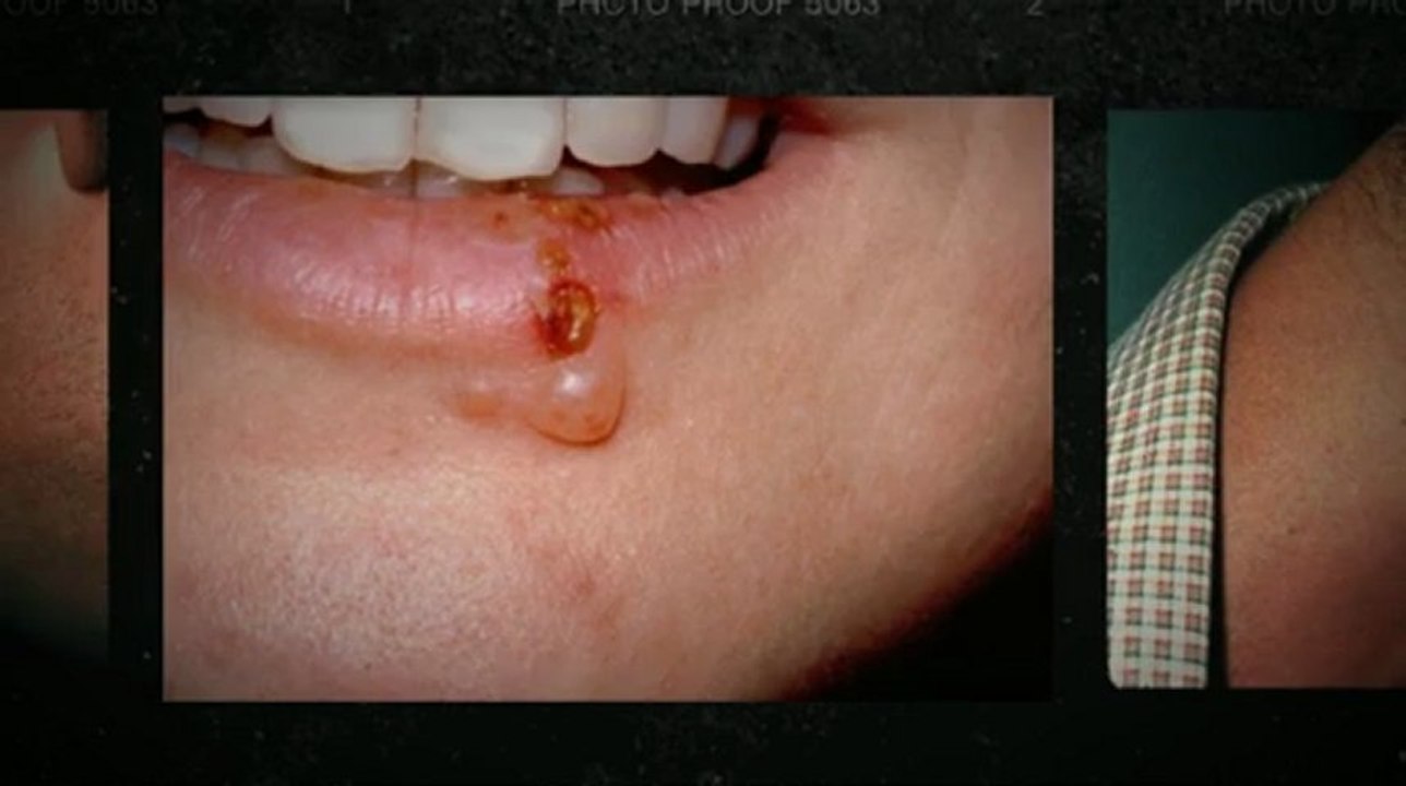 WHAT ARE HERPES