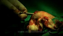 Surgery of Fibroid in Breast-hdv-fx-1-01-12.flv