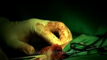 Surgery of Fibroid in Breast-hdv-fx-1-01-14.flv