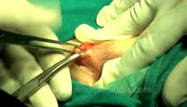Surgery of Fibroid in Breast-hdv-fx-1-01-27.flv