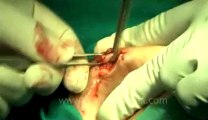 Surgery of Fibroid in Breast-hdv-fx-1-01-28.flv