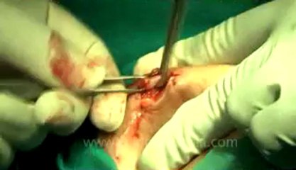 Surgery of Fibroid in Breast-hdv-fx-1-01-28.flv