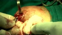 Surgery of Fibroid in Breast-hdv-fx-1-01-30.flv