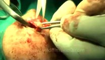 Surgery of Fibroid in Breast-hdv-fx-1-01-37.flv