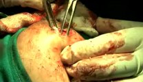 Surgery of Fibroid in Breast-hdv-fx-1-01-38.flv