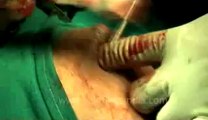 Surgery of Fibroid in Breast-hdv-fx-1-01-39.flv
