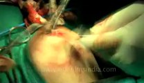 Surgery of Fibroid in Breast-hdv-fx-1-01-40.flv