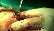 Surgery of Fibroid in Breast-hdv-fx-1-01-42.flv