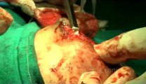 Surgery of Fibroid in Breast-hdv-fx-1-01-45.flv