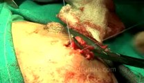 Surgery of Fibroid in Breast-hdv-fx-1-01-46.flv