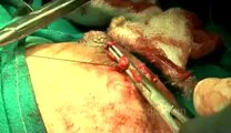Surgery of Fibroid in Breast-hdv-fx-1-01-47.flv