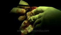 Surgery of Fibroid in Breast-hdv-fx-1-01-5.flv