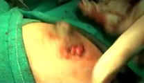 Surgery of Fibroid in Breast-hdv-fx-1-01-50.flv