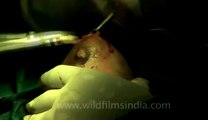 Surgery of Fibroid in Breast-hdv-fx-1-01-8.flv