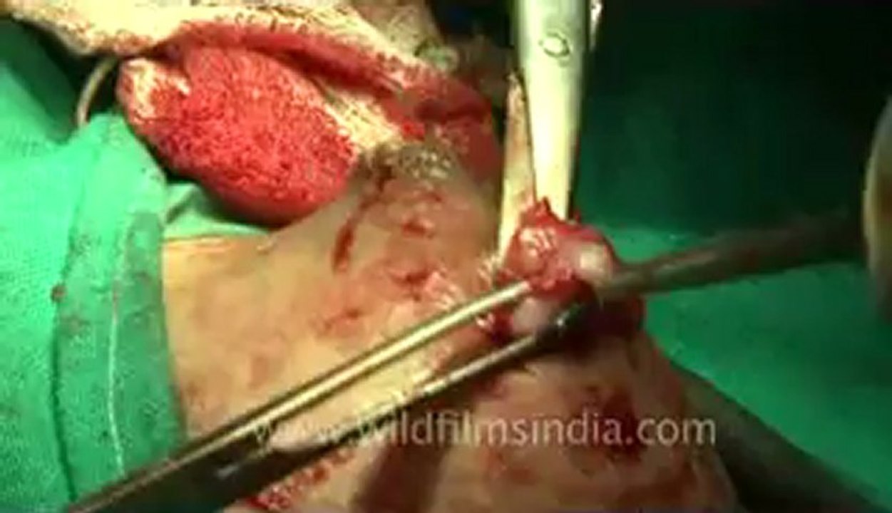 Surgery-2.flv