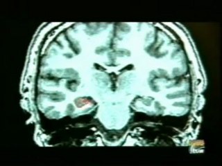 Glucosa y envejecimiento cerebral