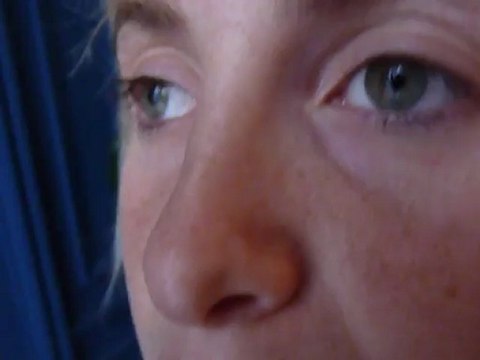 rhinoplastie avant apres, par voie fermée, vladimir mitz