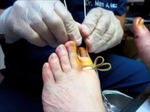 How to Remove an Ingrown Toenail - Tampa Foot Doctor