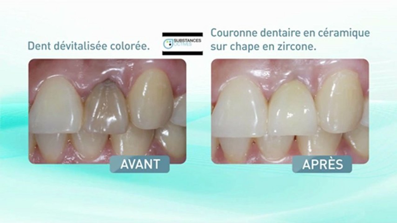 Couronne tout céramique