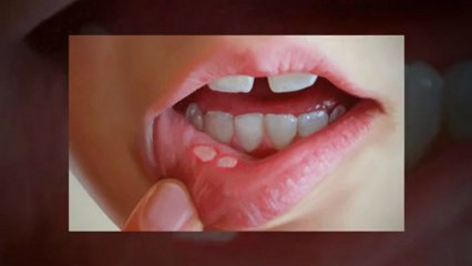 Canker sore treatment guide
