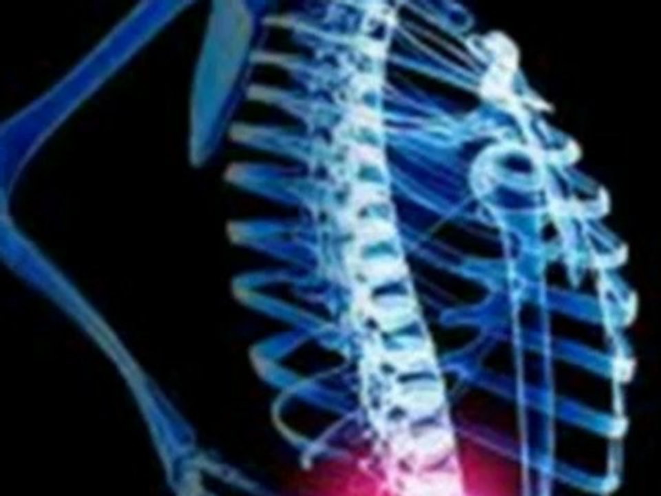 Migraine Headache,Knee Pain,Sports Injury ,Slipped Disc Pain Treatment by Prolotherapy