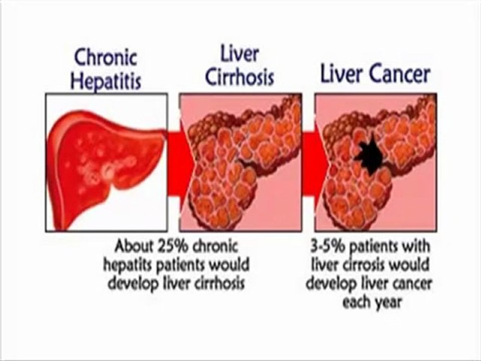 Ayurvedic Remedies Reviews:Home Remedies For Liver Cirrhosis Pain Treatment