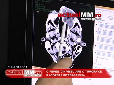 viseu actualmm spital cluj napoca