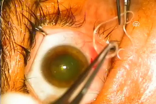 Gözünden solucan çıktı