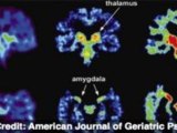 PET Scans May Show CTE in Living Football Players