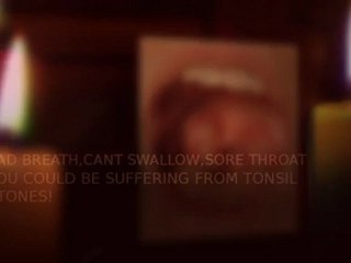 TONSIL STONES REMOVAL