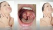 WHAT CAUSES TONSIL STONES