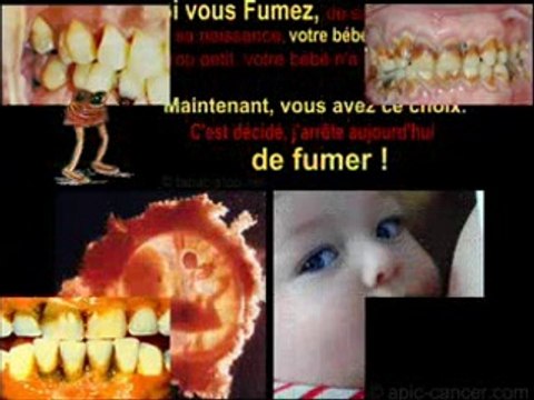 Fumer tue ... Ca vous fait quoi ?