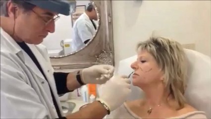 כיצד מתבצע מילוי קמטים?