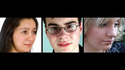 Acne No More - Natural Cures for Acne