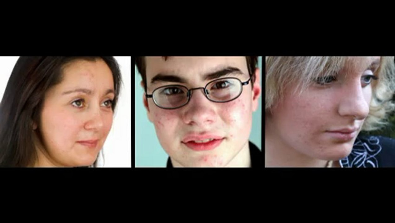 Acne No More - Natural Cures for Acne
