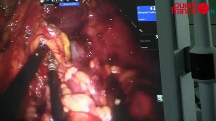 Santé : ablation d'un rein par un robot