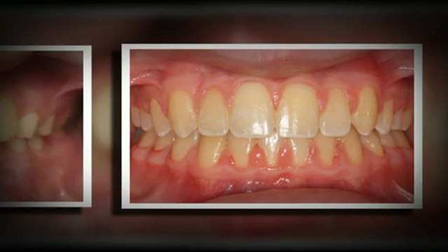 Invisalign Dallas Jan2013