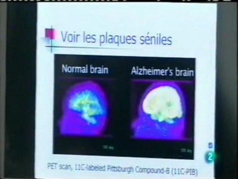 El misterio de los centenarios: Investigacion genetica (Gen APO-E2)