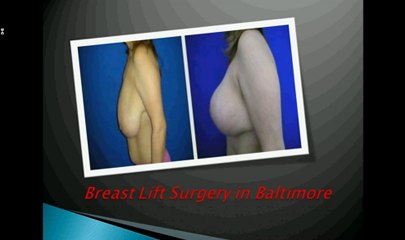 Nipple Reduction - Breast Augmentation Baltimore