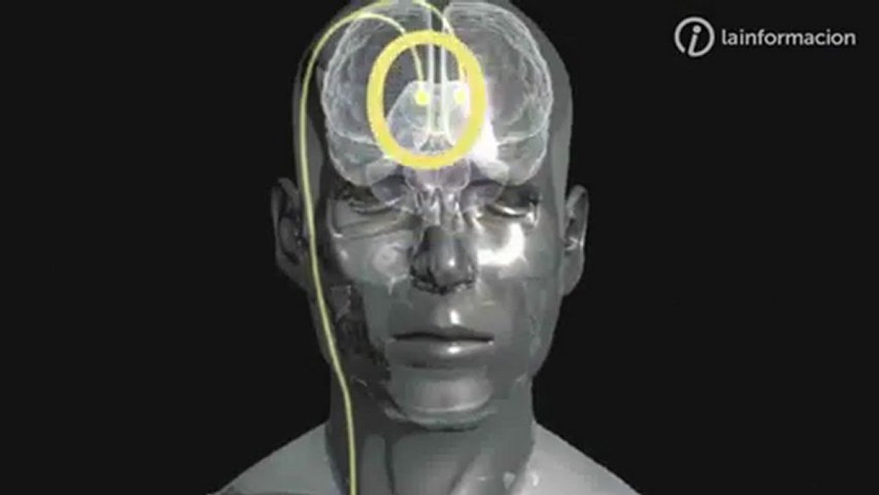 Neuroprotesis para el Parkinson: Estimulacion cerebral profunda