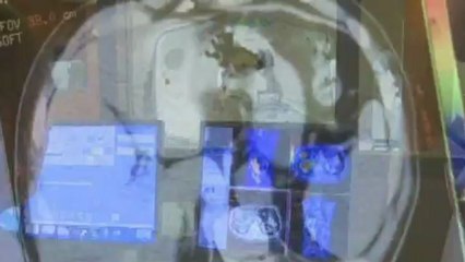 Revolutionary new cancer treatment being developed in the US