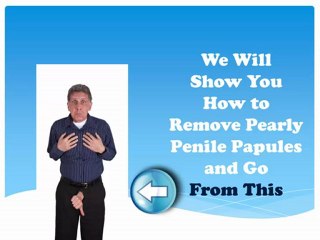 Removing Those Embarrassing Pearly Penile Papules