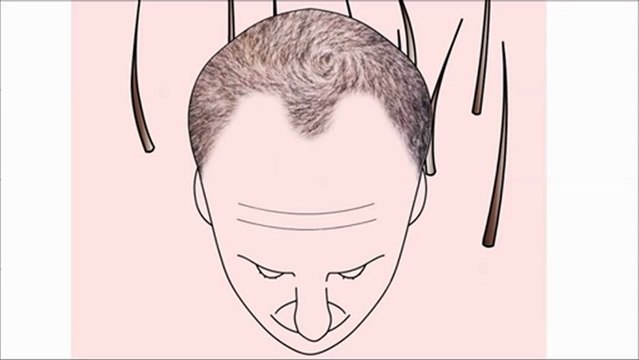 FUE Saç Ekimi - Rota Hairtrans Saç Ekim Merkezi İstanbul