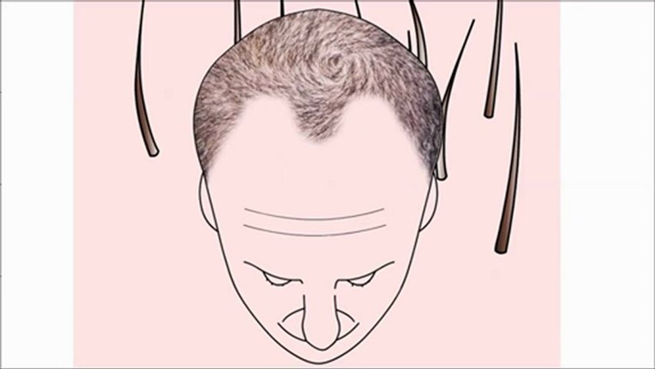 FUE Saç Ekimi - Rota Hairtrans Saç Ekim Merkezi İstanbul