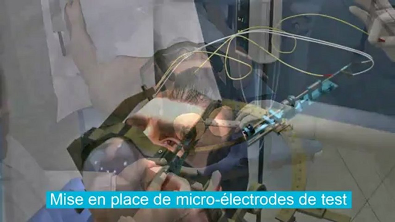 Animation Implantation DBS