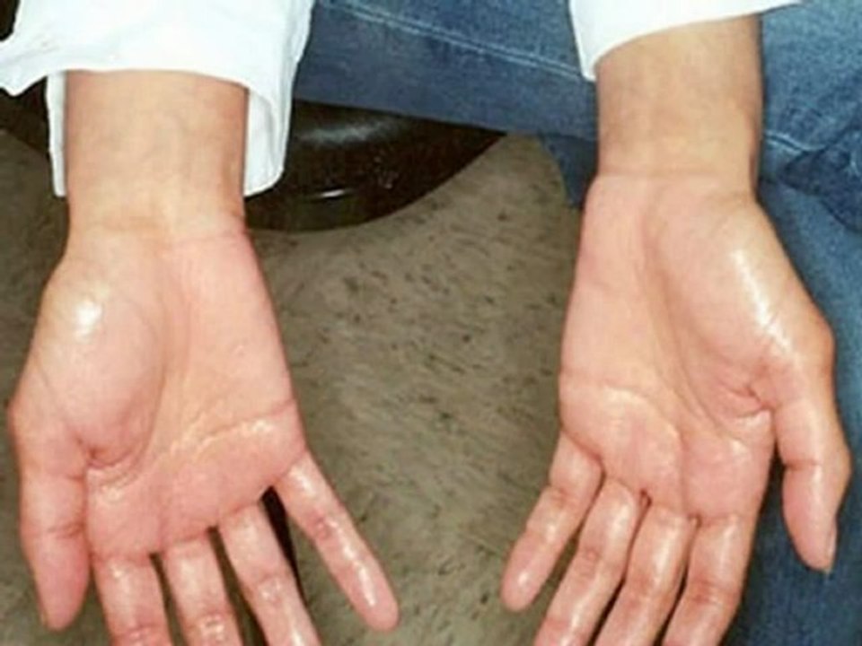 Remedies for Sweaty Hands and Feet