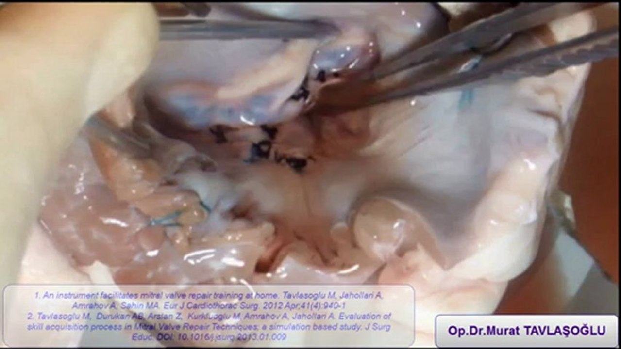 Posterior-anterior chorda nakli- posterior quadranguler rezeksiyon-anteriortrianguler rezeksiyon