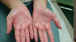 How Can I Get my Hands to Stop Sweating?